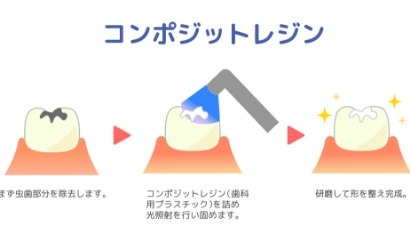 コンポジットレジン修復